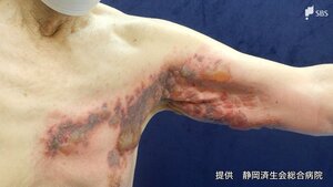 「帯状疱疹」が20～40代に増えているワケは“水痘ワクチン”接種⁉ 回数も「一生に一度」ではない⁉