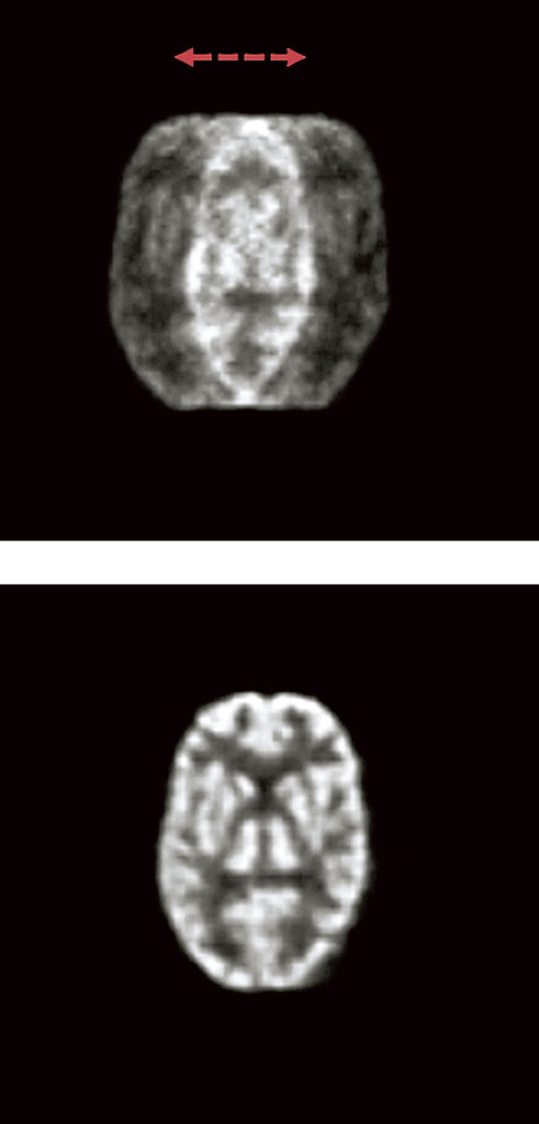 脳の模型による画像イメージ。左右に動いた画像（上）と動きを補正した画像