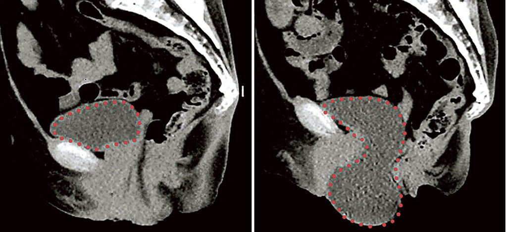 骨盤臓器脱のＣＴ画像。従来のＣＴ（左）では正常な位置にあるぼうこう（点線内）が、立って撮ると骨盤から垂れ下がっている（慶応大提供）