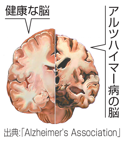 健康な脳とアルツハイマー病の脳
