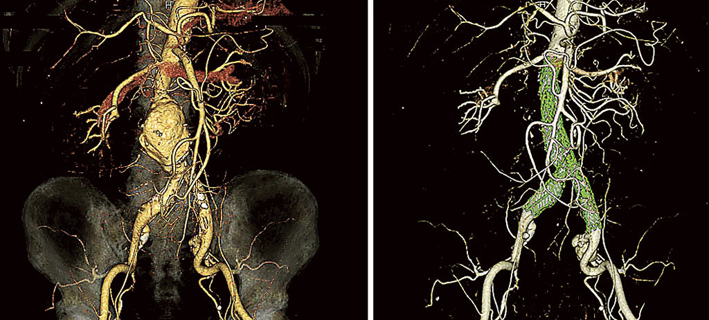 カテーテル治療を受けた６６歳男性のＣＴ画像。治療前（左）は腹部大動脈の分岐部にあった直径５・５センチのこぶが、ステントグラフト（緑色）を入れた後は見えなくなった（慶友会つくば血管センター提供）